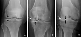 X-Ray Arthrose Image